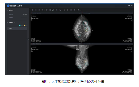 人工智能技术辅助乳腺癌筛查，更快更准的帮到更多人