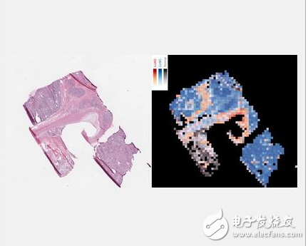 人工智能在医学领域应用新突破：助力肺癌的诊断，减轻医生的压力